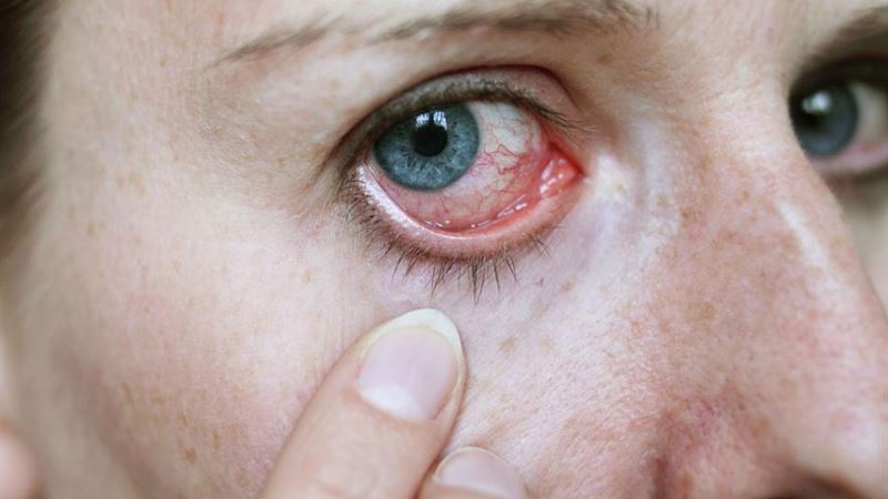 Comprehensive Guide to Managing Pink Eye with Proper Eye Drops and Treatments