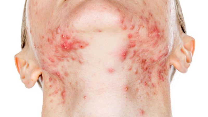 Understanding Hepatitis C: Transmission, Risks, and Prevention Strategies