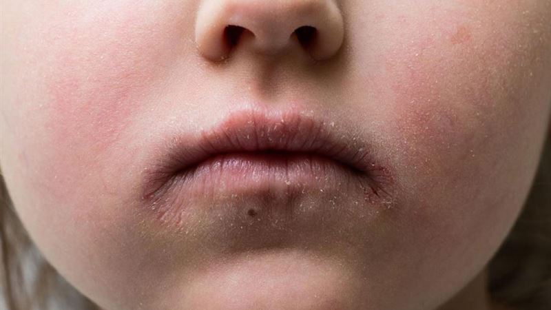 Comprehensive Guide to the Causes and Prevention of Impetigo in Children and Adults