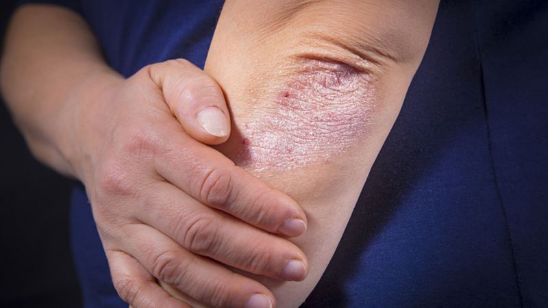 Understanding Psoriasis: Symptoms and Contributing Factors