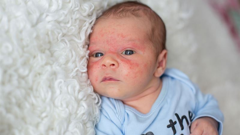Understanding How Baby Eczema Changes with Age and the Role of Steroid Therapy