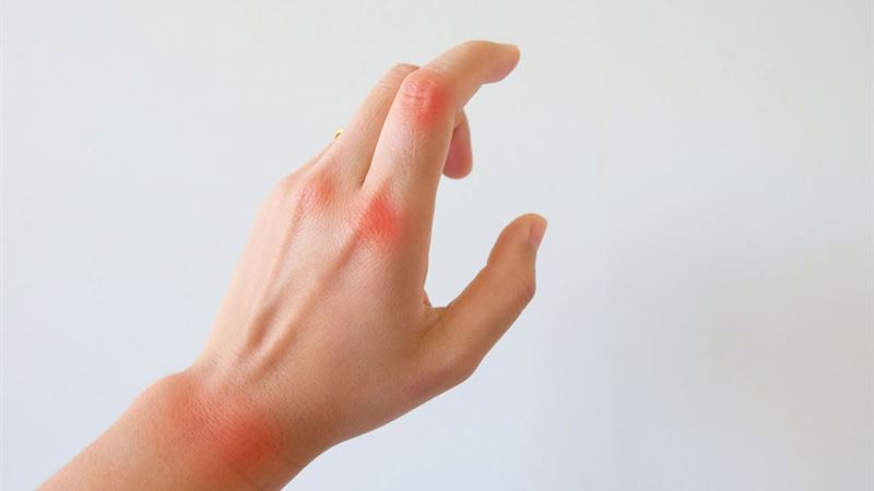 Comprehensive Guide to Common Rheumatoid Arthritis Treatments You Should Know