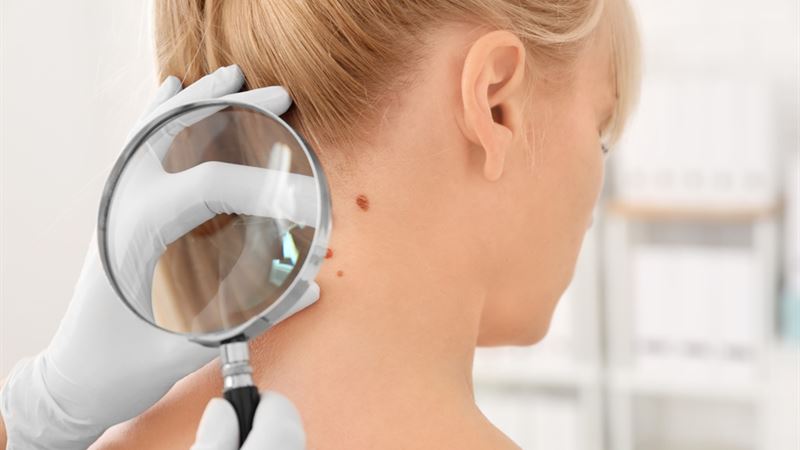 Comprehensive Guide to Skin Cancer: Prevention, Detection, and Treatment