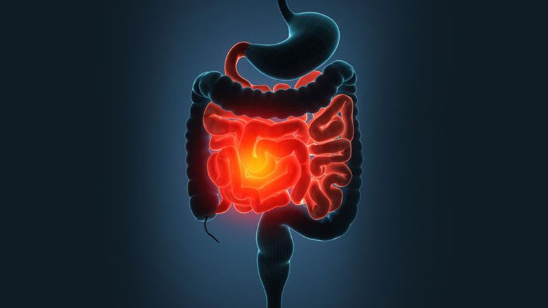 Comprehensive Guide to Managing Ulcerative Colitis Through Dietary Choices