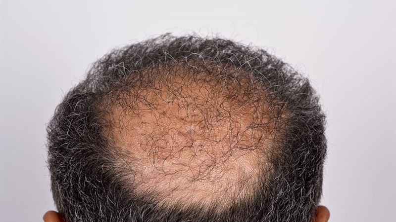 Comprehensive Guide to Hair Transplantation: Types, Procedures, and Costs