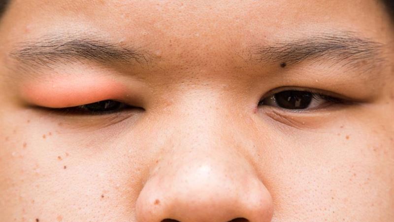 Effective Home Remedies for Common Eye Infections