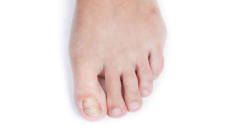 Comprehensive Guide to Treating Toenail Fungal Infections