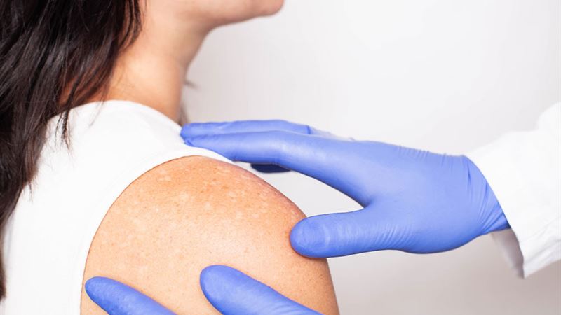 Comprehensive Guide to Vitiligo: Symptoms, Causes, and Effective Management Strategies