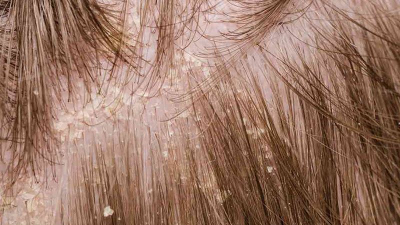 Comprehensive Mild Strategies for Managing Scalp Psoriasis Effectively