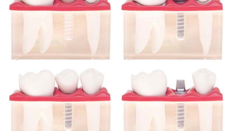 Comprehensive Guide to Dental Crowns and Caps: Types, Materials, and Maintenance