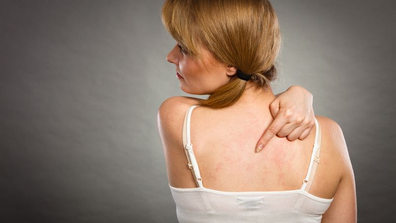 Comprehensive Guide to Managing and Healing Eczema at Home and Through Medical Treatments