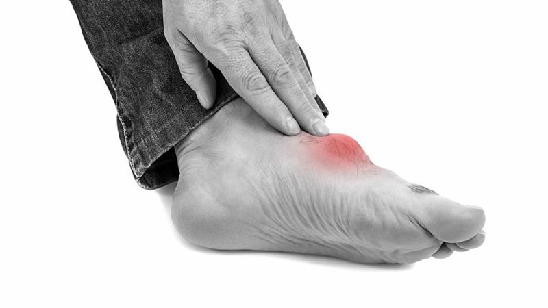 Comprehensive Guide to Gout: Causes, Symptoms, and Home Remedies for Relief