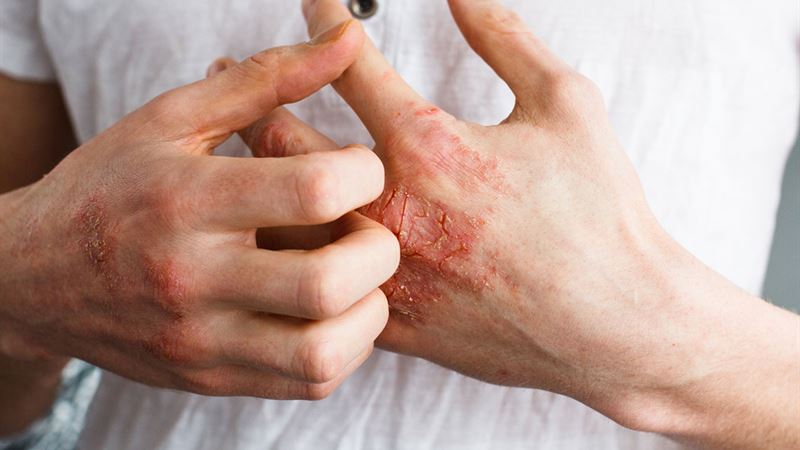 Comprehensive Guide to Foods Beneficial and Harmful for Eczema Sufferers