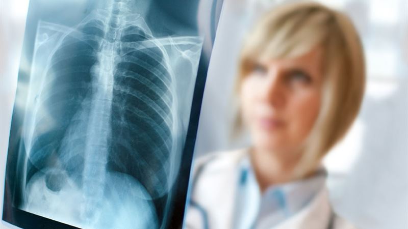 Comprehensive Guide to Recognizing, Diagnosing, and Managing Lung Cancer