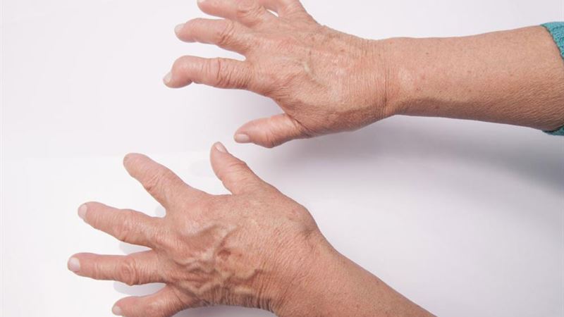 Comprehensive Guide to Rheumatoid Arthritis and Lupus: Symptoms, Causes, and Management