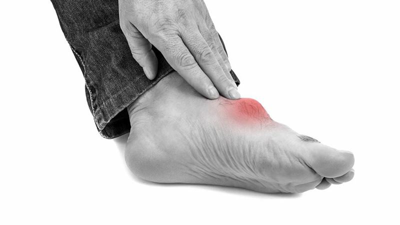 Common Causes and Triggers of Gout Foot Pain: How to Prevent Flare-Ups