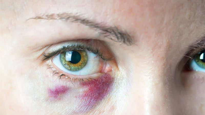 Effective Home Strategies for Accelerating Bruise Recovery