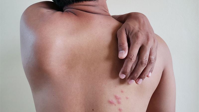 Comprehensive Guide to Managing and Preventing Shingles