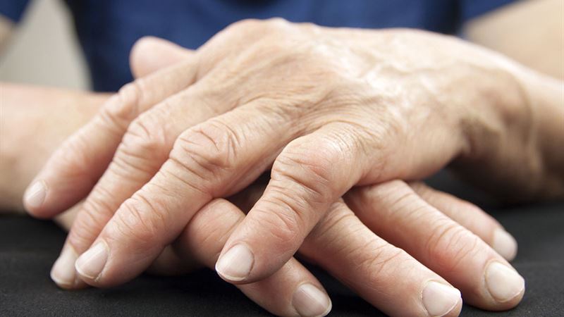 Understanding Arthritis: Progression, Diagnosis, and Effective Prevention Strategies