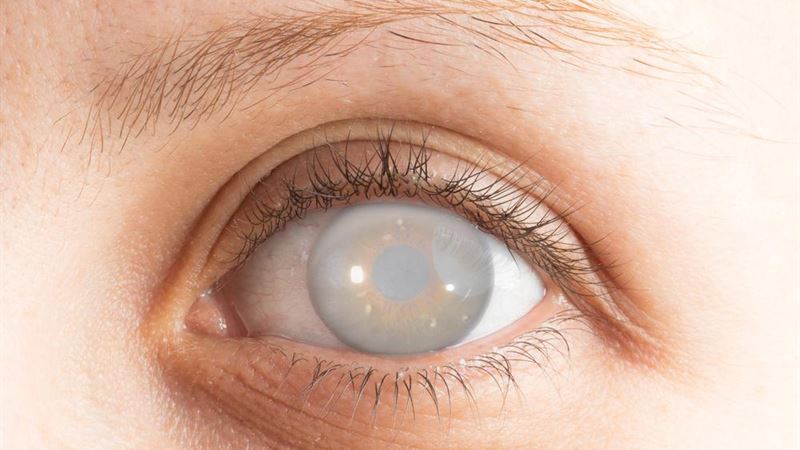Comprehensive Guide to Cataracts and Their Surgical Treatments