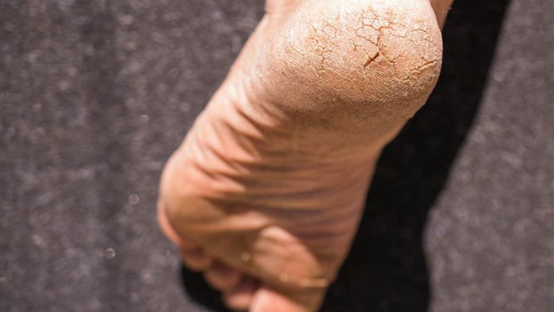 Natural Strategies to Alleviate Heel Pain and Promote Faster Recovery