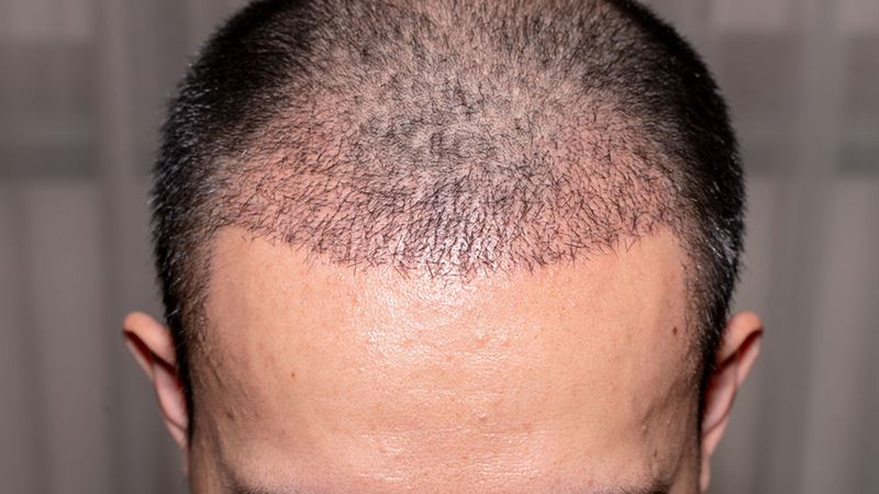 Comprehensive Guide to Hair Transplantation: Types, Advantages, and Expert Selection Tips