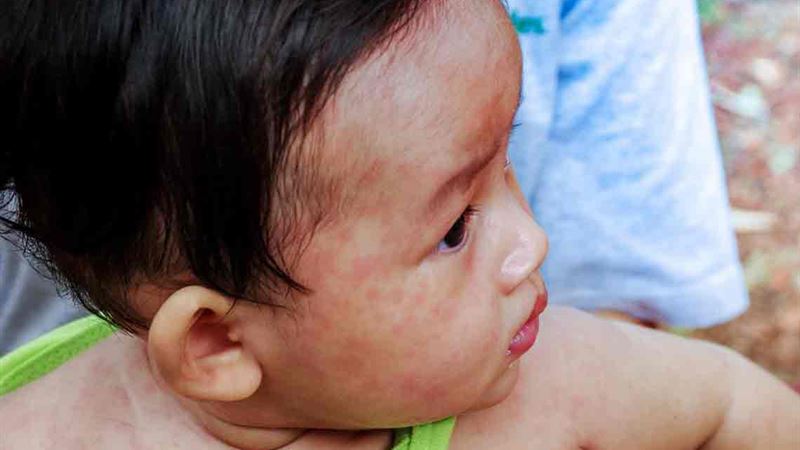 Comprehensive Guide to Shingles: Causes, Symptoms, and Effective Treatment Options