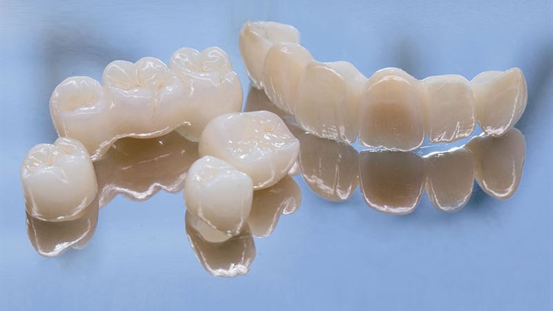 Comprehensive Guide to Dental Bridges: What You Must Know Before Getting One