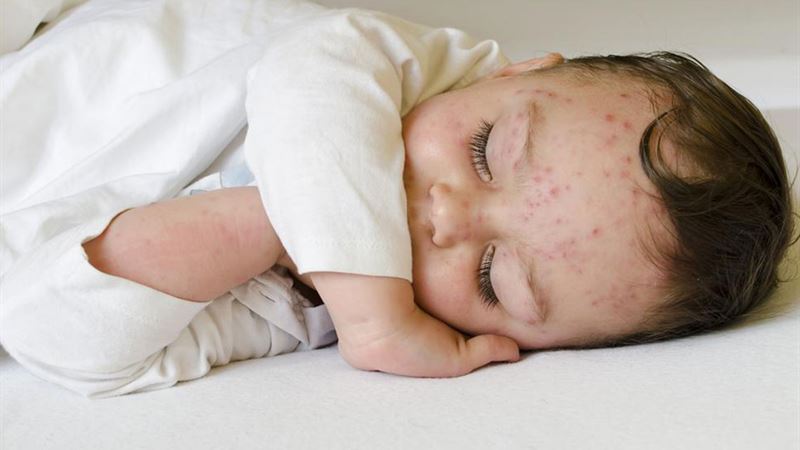 Comprehensive Guide to Managing and Treating Baby Skin Rashes Effectively