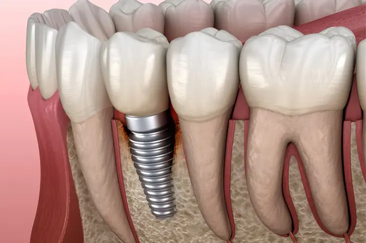 Comprehensive Guide to Affordable Dental Implant Solutions