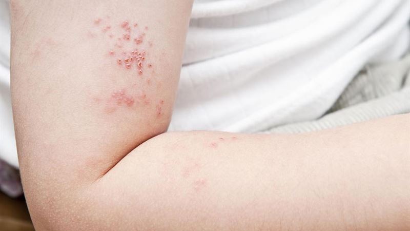Comprehensive Strategies to Prevent Shingles Before It Manifests