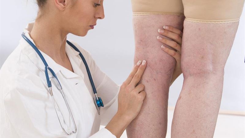 Comprehensive Approaches to Managing and Treating Varicose Veins