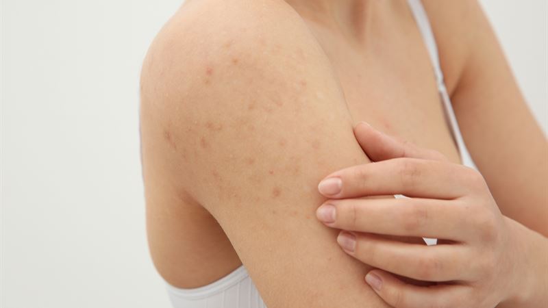 Comprehensive Guide to HIV-Related Skin Rashes: Causes, Symptoms, and Treatments