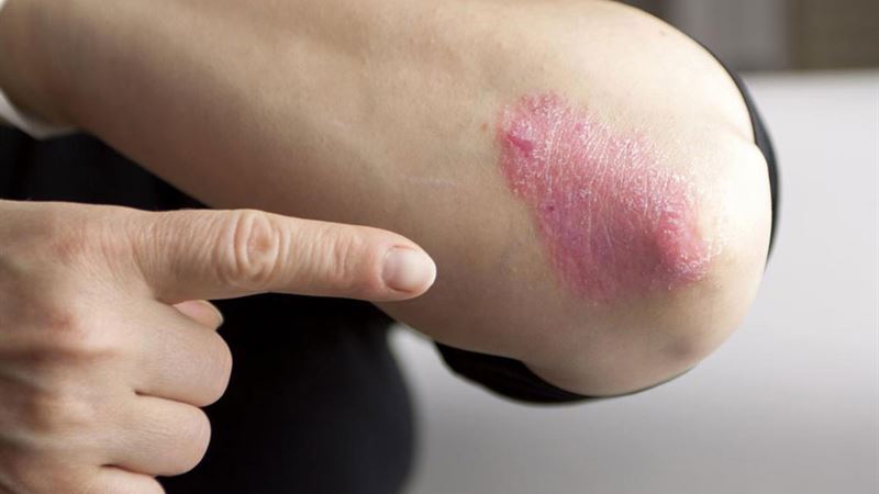 Comprehensive Strategies for Managing Moderate to Severe Plaque Psoriasis