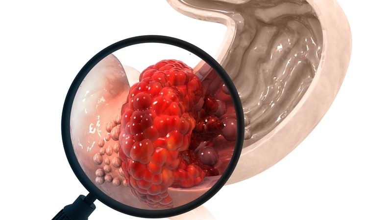 Innovative Therapies for Gastrointestinal Stromal Tumors: The Role of Ripretinib and Ayvakit in Advanced GIST Management