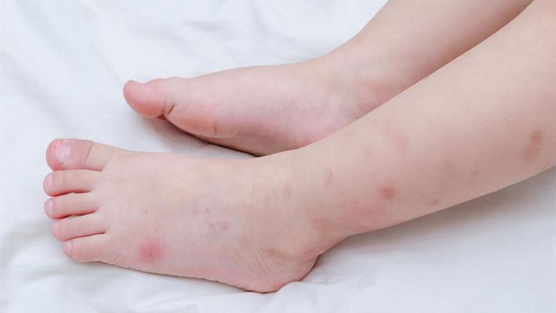 Comprehensive Guide to Recognizing Insect Bites Quickly and Effectively