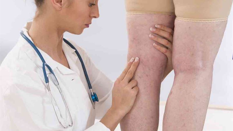 Comprehensive Guide to Recognizing and Managing Deep Vein Thrombosis Symptoms