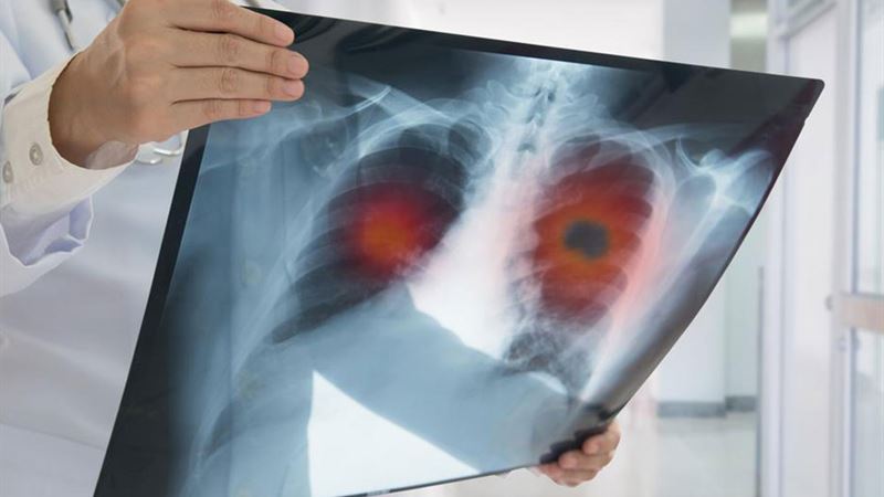 Comprehensive Resources and Support Networks for Lung Cancer Patients