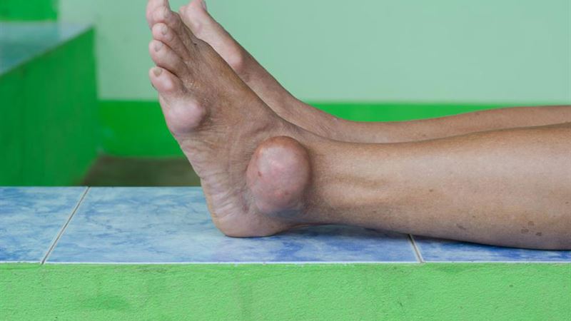 Effective Strategies for Managing Gout Flare-Ups and Prevention Techniques
