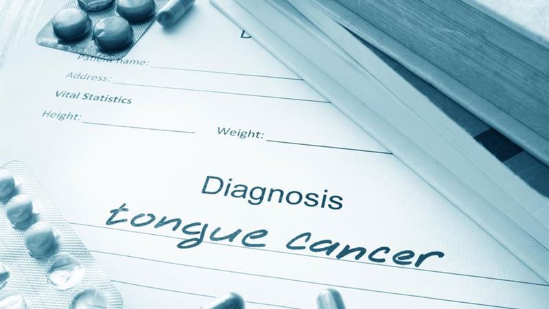 Comprehensive Guide to Recognizing Early Signs and Symptoms of Tongue Cancer