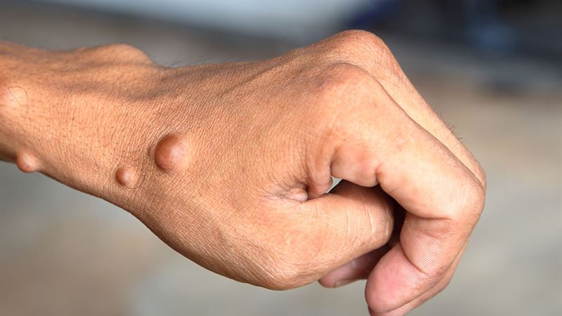 Understanding Neurofibromatosis: Symptoms, Causes, and Related Conditions