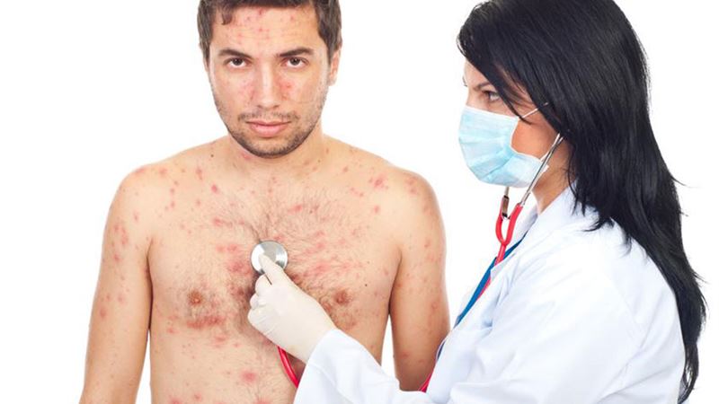 Understanding the Impact of Staphylococcus on Health: Common Conditions and Symptoms