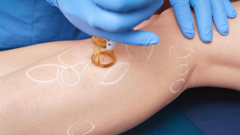 Comprehensive Guide to Treating Leg Cellulitis Effectively