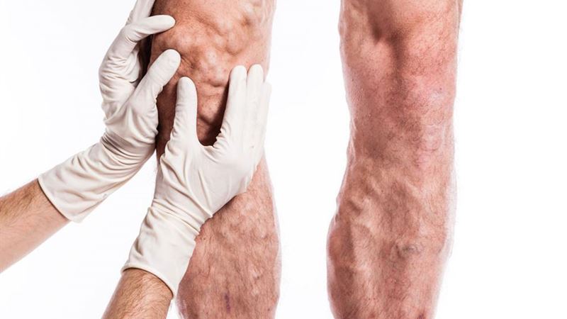 Comprehensive Guide to Recognizing and Preventing Deep Vein Thrombosis