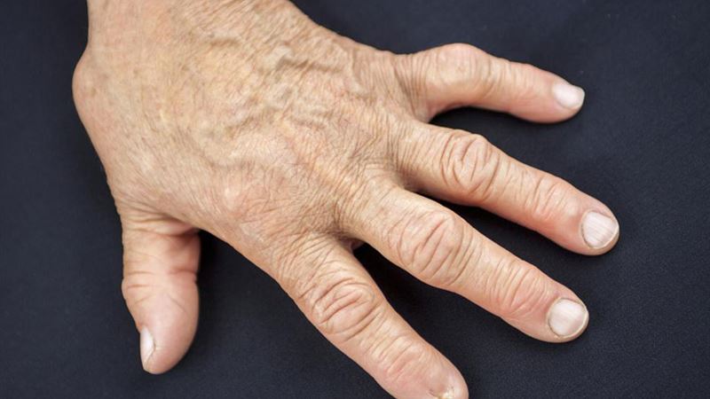 Recognizing Early Symptoms of Rheumatoid Arthritis for Prompt Diagnosis