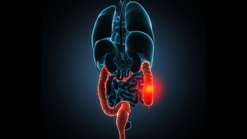 Effective Strategies and Treatments for Managing Irritable Bowel Syndrome (IBS)