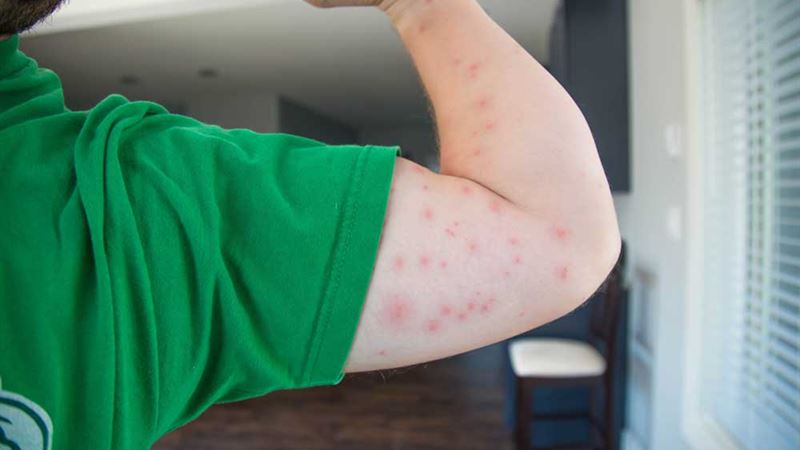 Comprehensive Guide to Recognizing and Managing Bedbug Bites