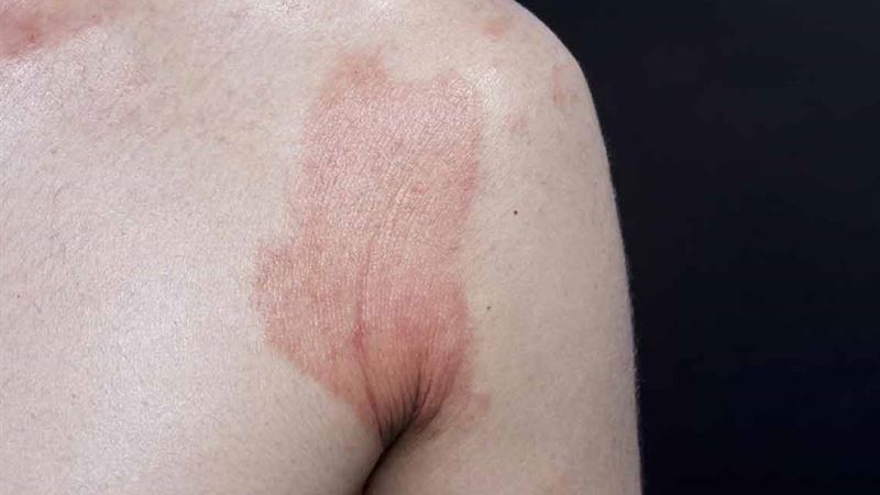 Comprehensive Guide to Recognizing and Managing Skin Rashes