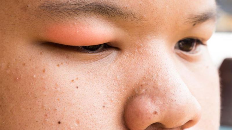 Comprehensive Guide to Understanding the Causes of Eyelid Styes and Their Symptoms