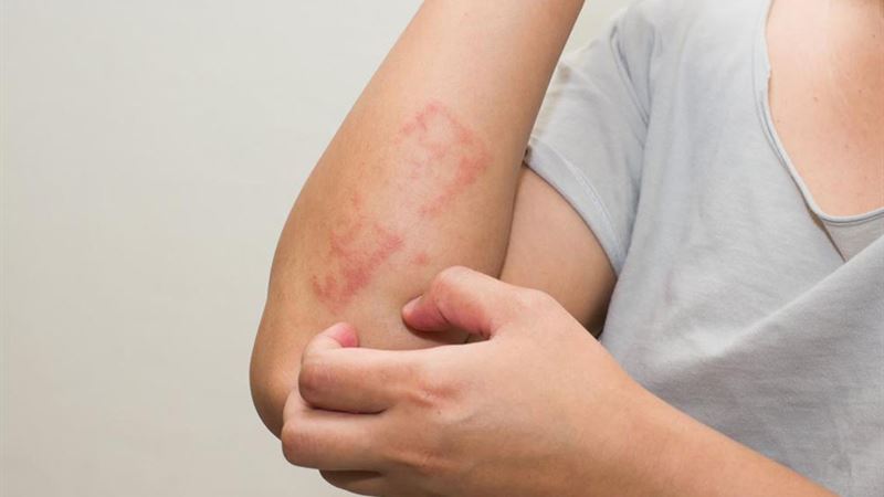 Comprehensive Guide to Atopic Dermatitis: Causes, Symptoms, and Effective Management Strategies